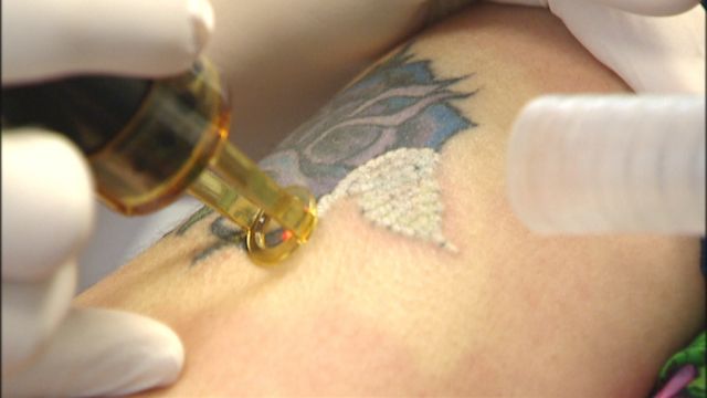 Удаление татуировок неодимовым лазером